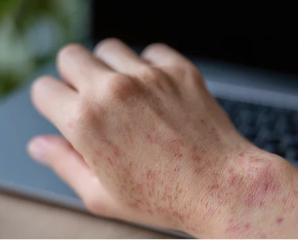 maintenance treatments for glutathione injection before and after results